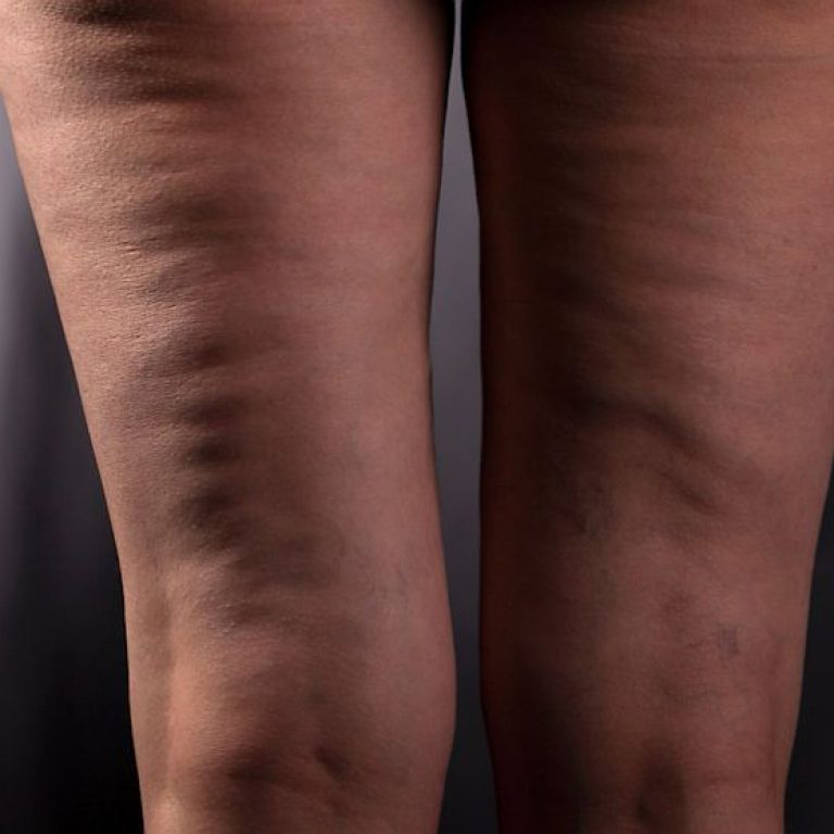 Cellulite